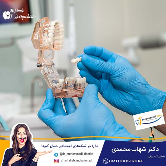 زمان انجام ایمپلنت دندان در ایمپلنت های فوری و ایمپلنت های بلند مدت چقدر است؟ - کلینیک دندانپزشکی دکتر شهاب محمدی